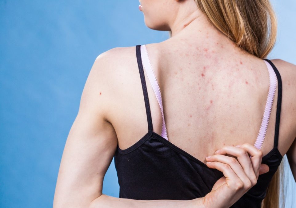 back and shoulder acne