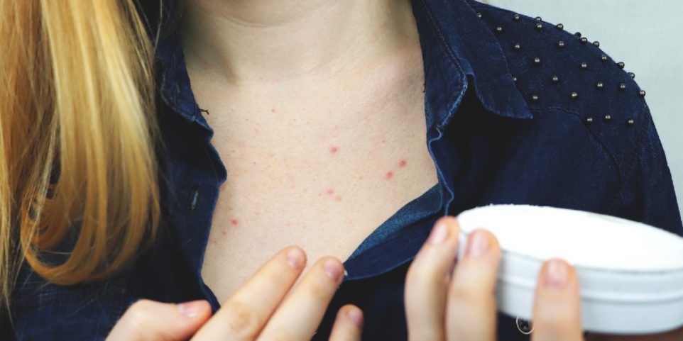 Young woman with pimples on the chest, closeup