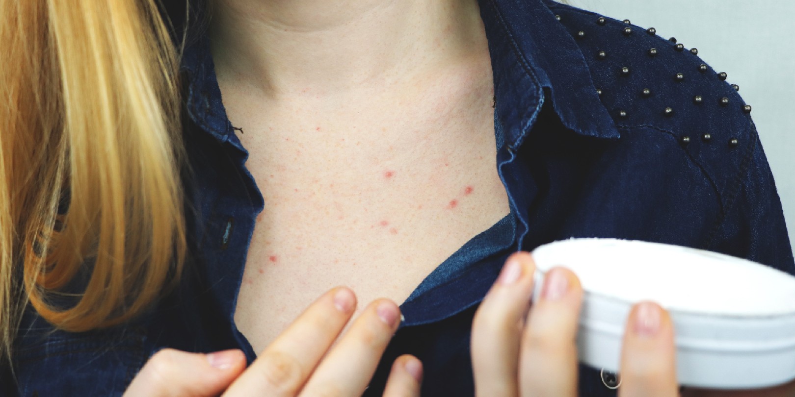 Clear Skin 101: Chest Acne Causes and Affordable Treatments | Buyers Report