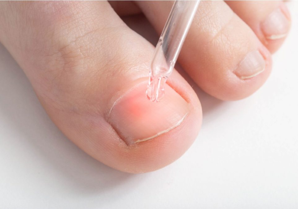 best nail fungus treatment