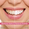 Before and after photo showing the effectiveness of the Rembrandt Stain Remover for Teeth: on the left, teeth appear stained and dull, while on the right, teeth are noticeably whiter and brighter.