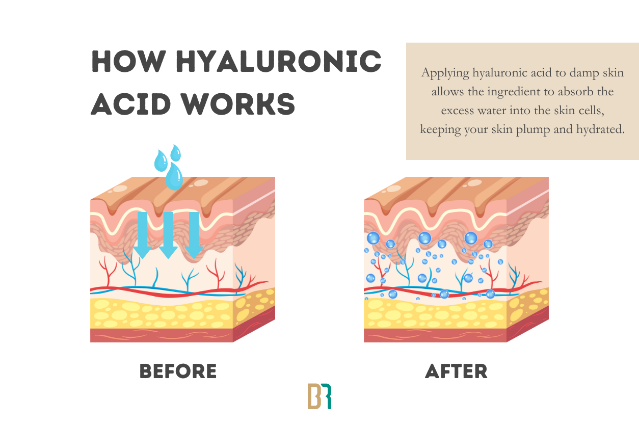 Is Hyaluronic Acid Good for Acne?