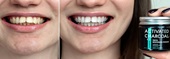 Before and after photo showing the effectiveness of the Sunatoria Stain Remover for Teeth: on the left, teeth appear stained and dull, while on the right, teeth are noticeably whiter and brighter.