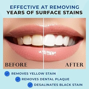 Before and after split image of a woman smiling, showing stained teeth on the left and whiter teeth on the right after using the Venus Visage Stain Remover for Teeth.